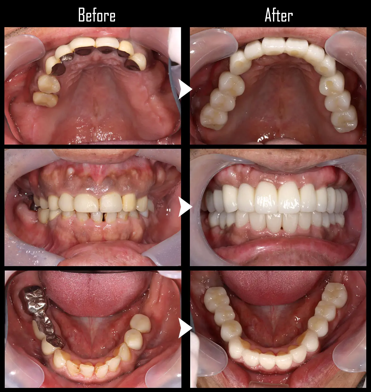 症例All-on-4（オール・オン・フォー）