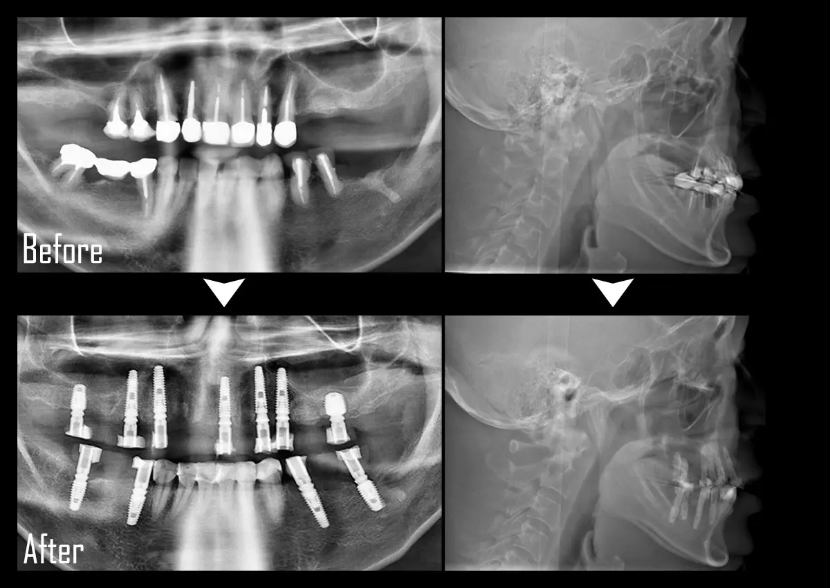 症例All-on-4（オール・オン・フォー）