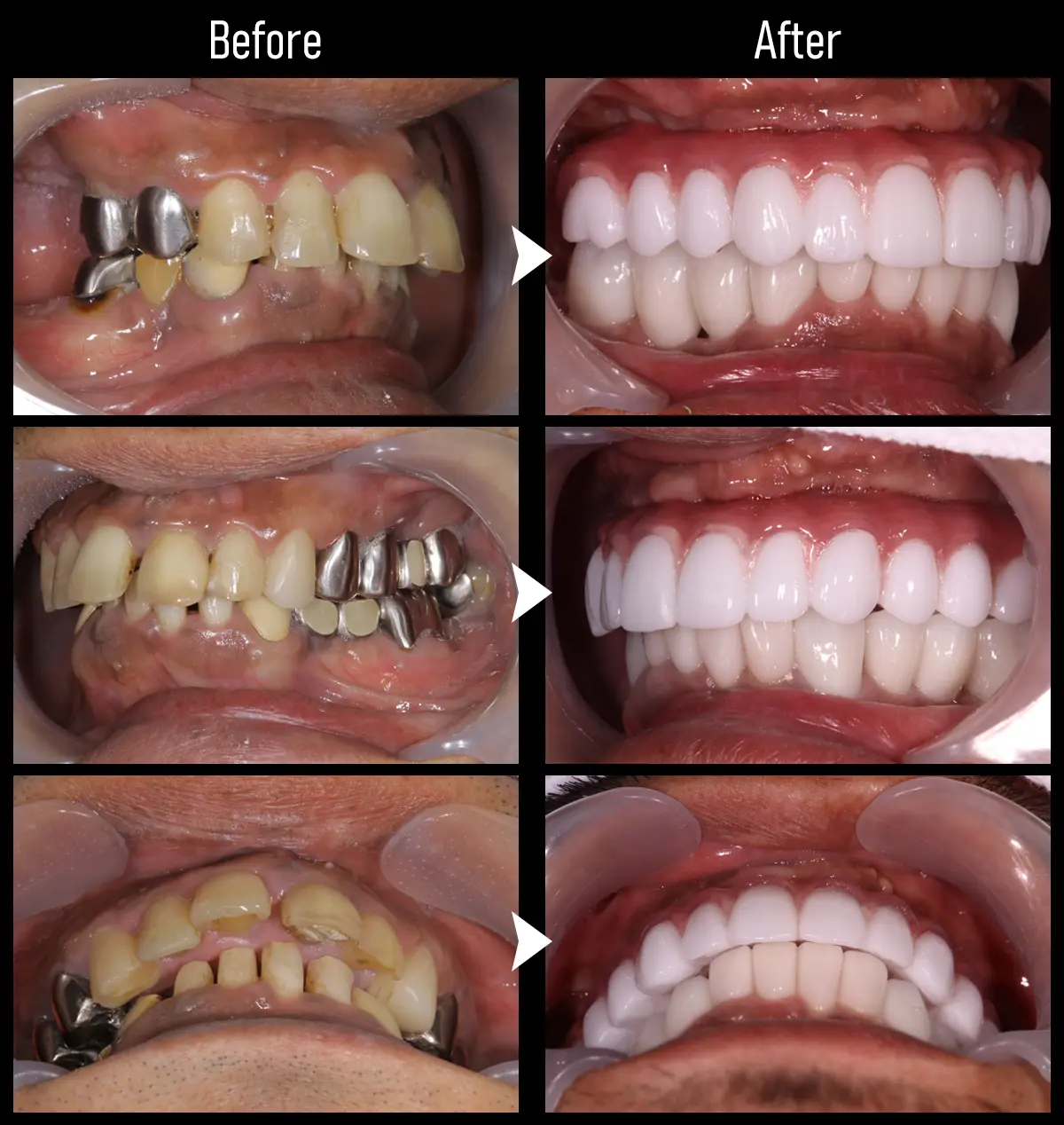 症例All-on-4（オール・オン・フォー）