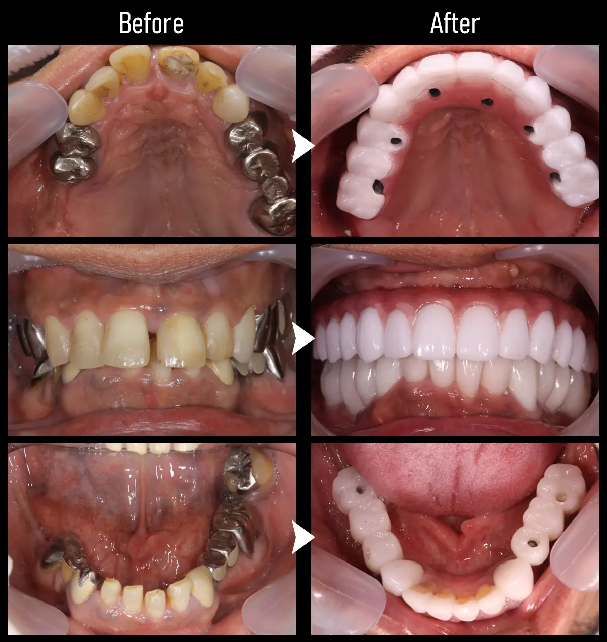 症例All-on-4（オール・オン・フォー）