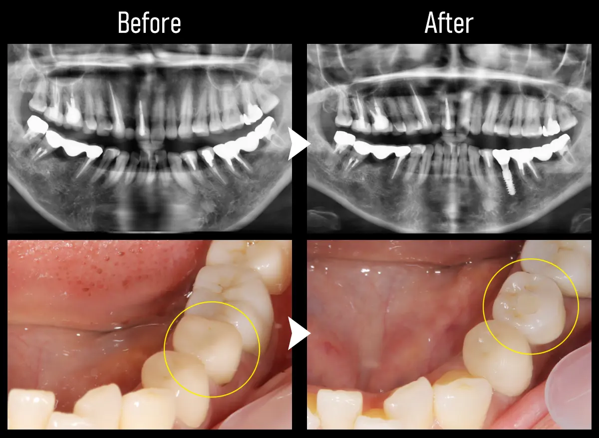 症例All-on-4（オール・オン・フォー）