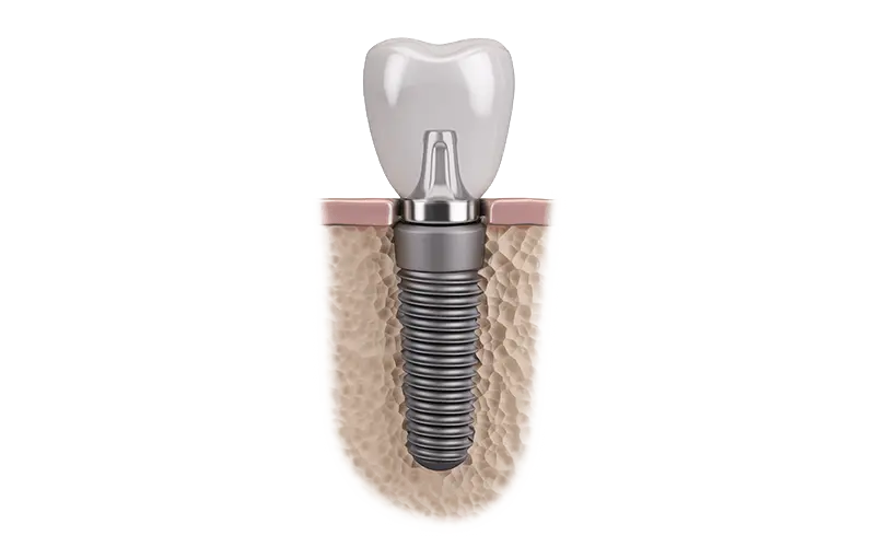 通常のインプラント