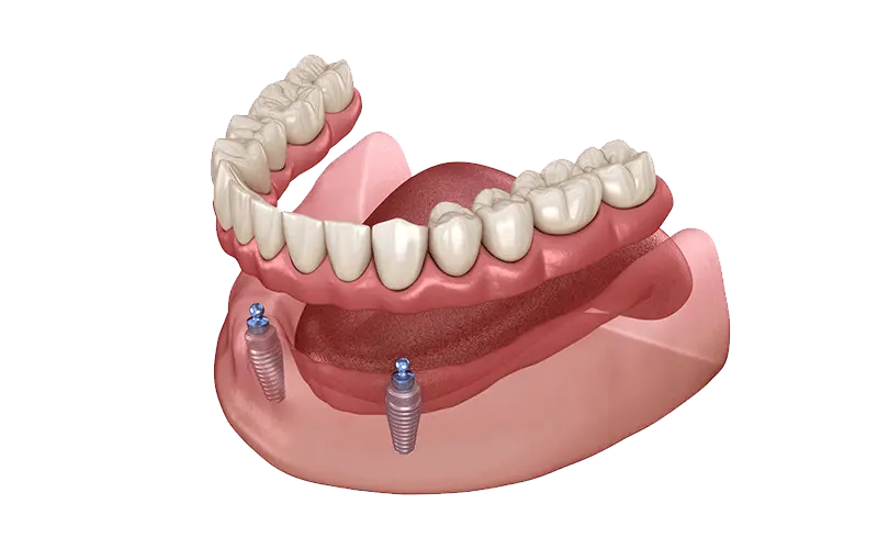 インプラントオーバーデンチャー