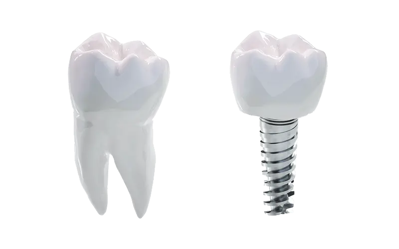 抜歯即時インプラント